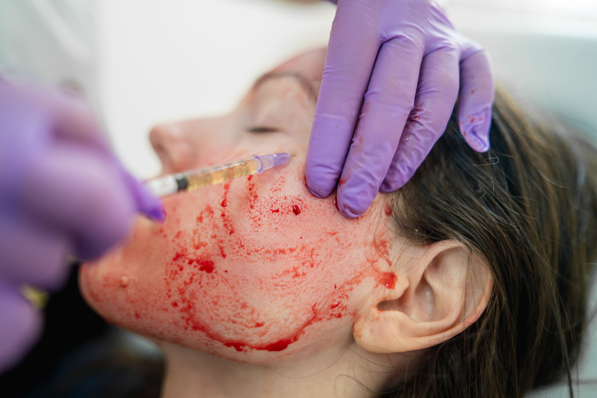 Vampire Therapy: The Extraordinary Treatment That Can Reverse Aging